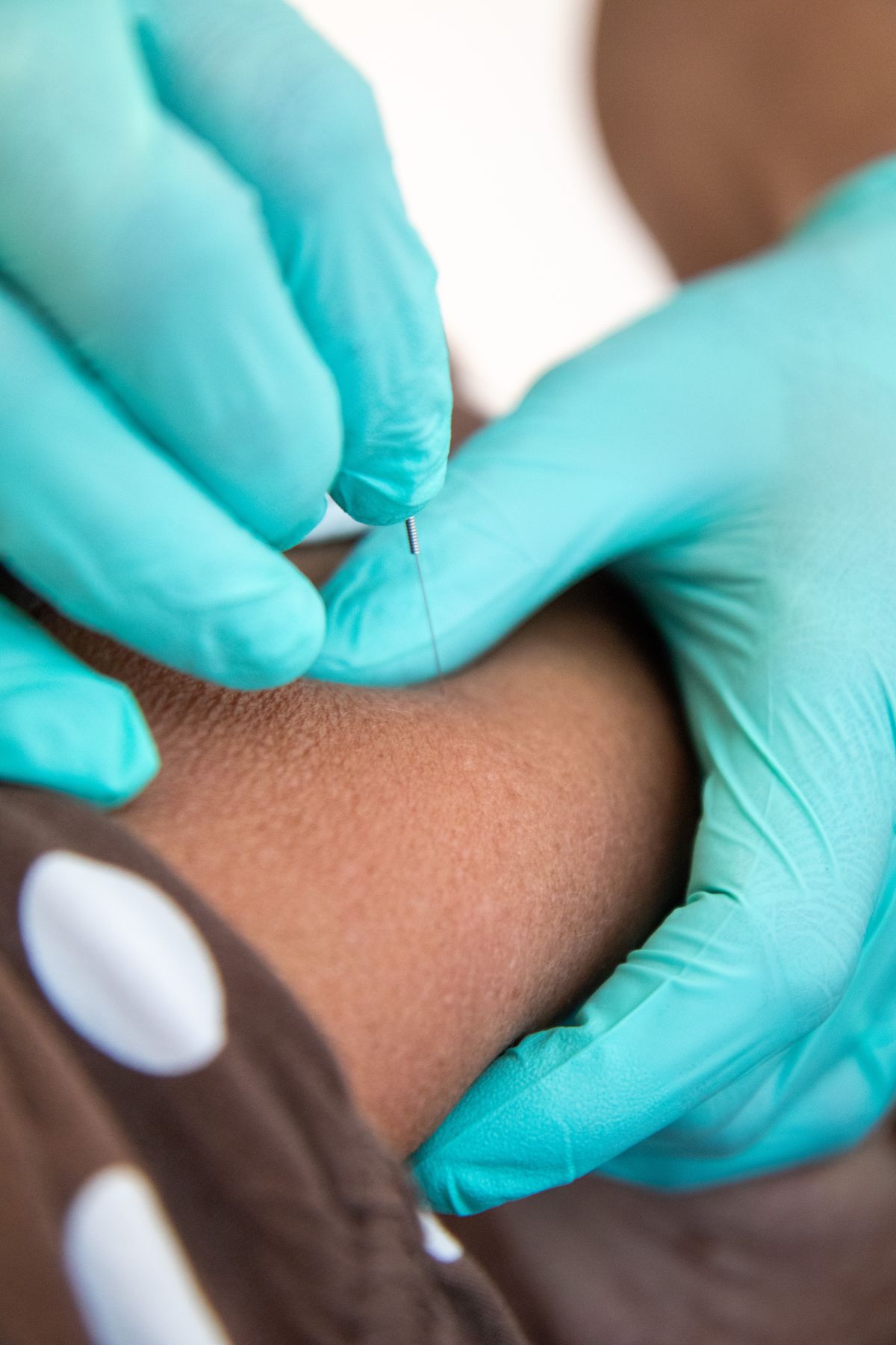 Dry needling