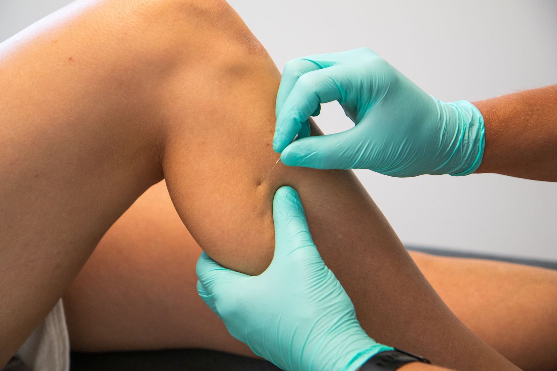 Dry needling van de knie