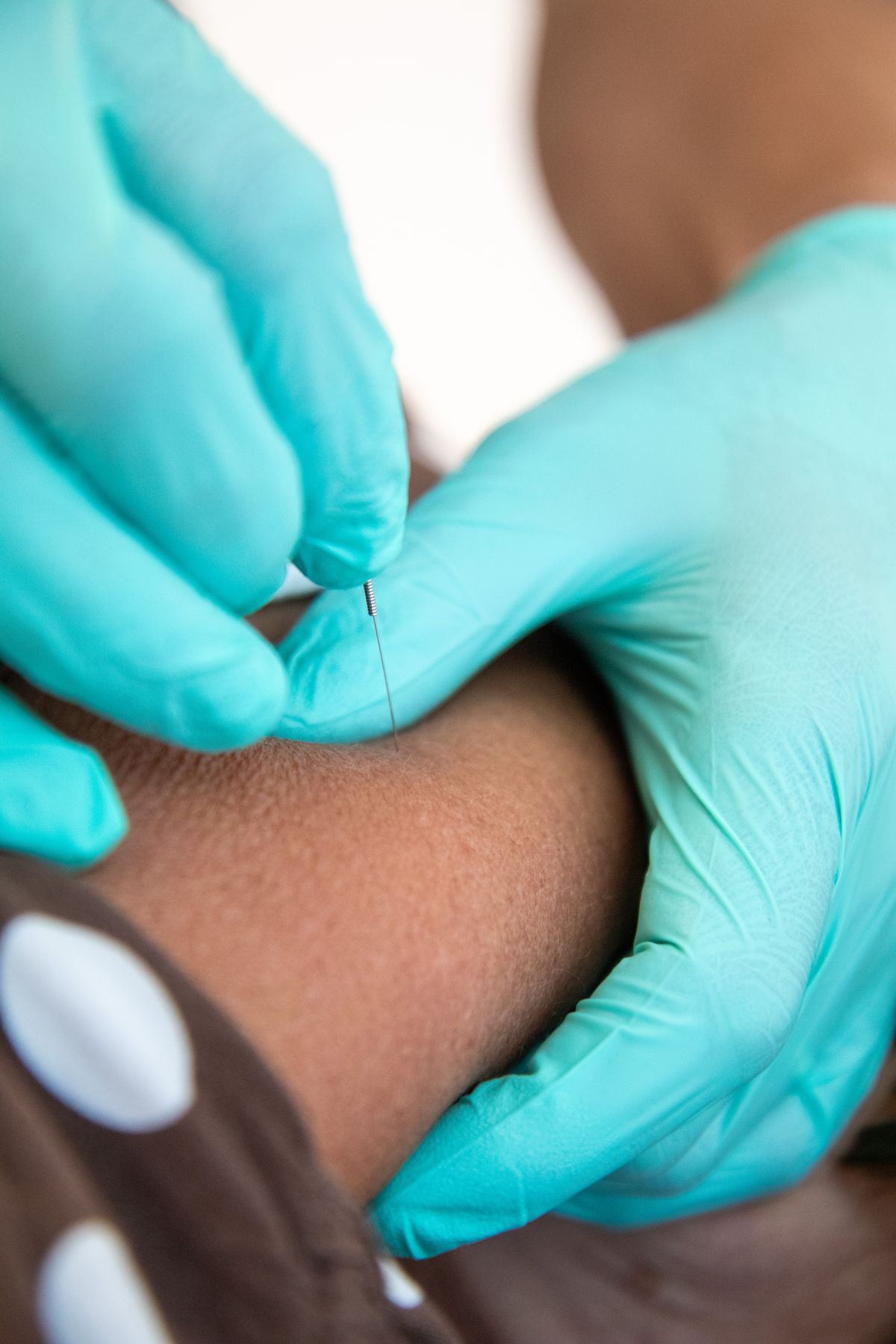 Dry needling